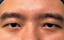 “双眼皮”常见问题，华山医院整形外科为您解答