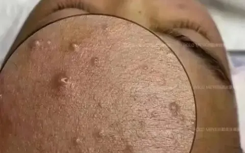 治疗青春痘的面膜